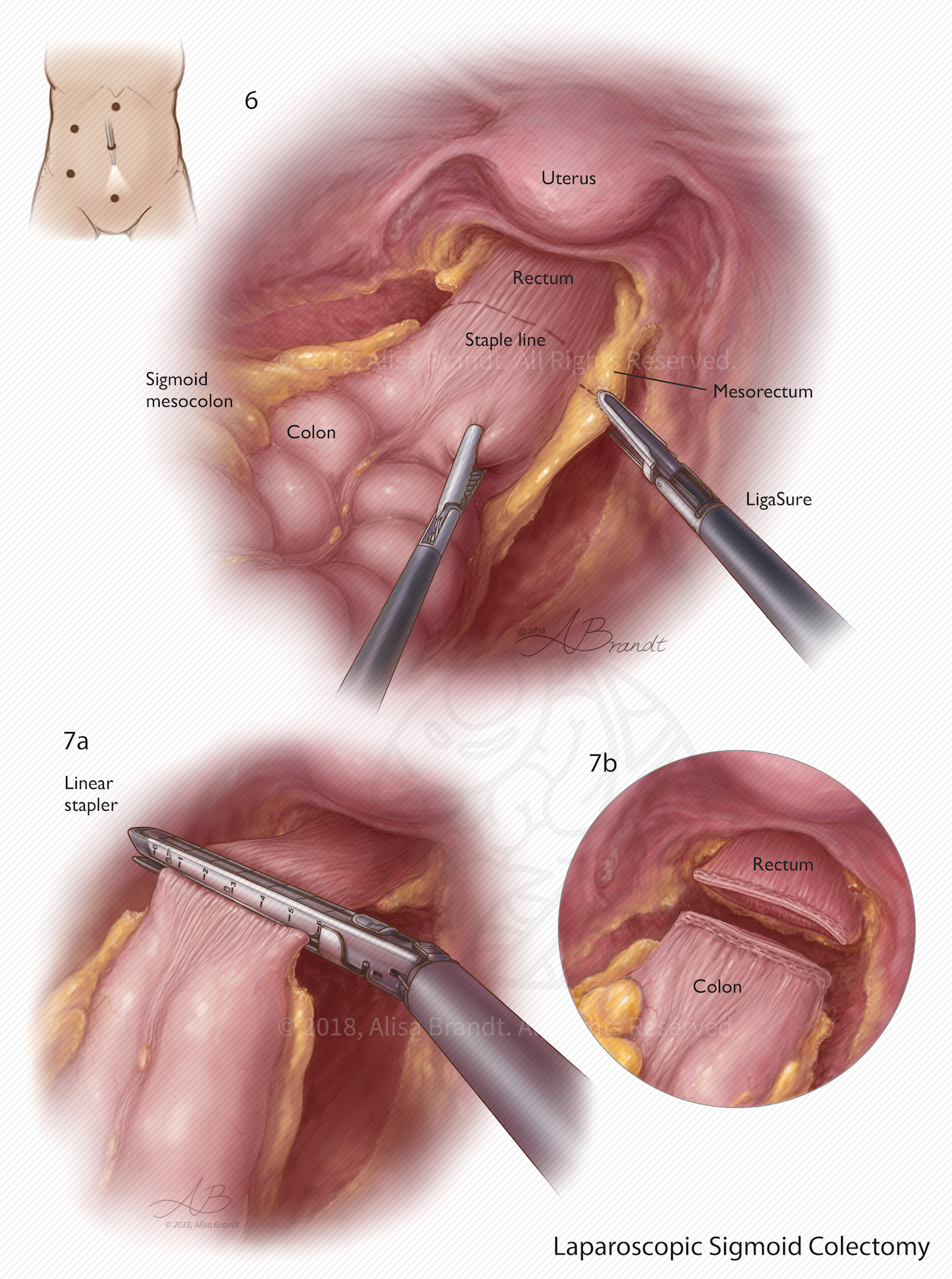 Laparoscopic sigmoid colectomy surgical illustration