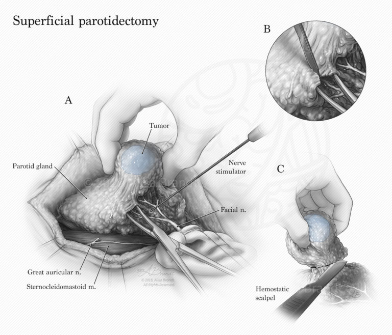 Superficial Parotidectomy – Alisa Brandt's Portfolio