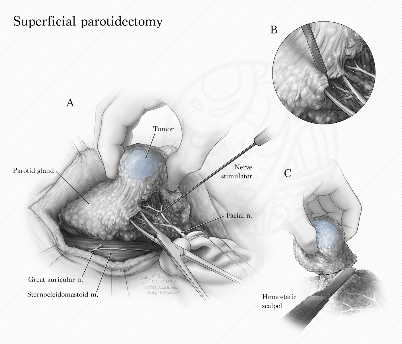 Superficial parotidectomy surgical illustration
