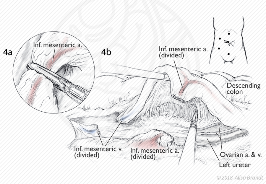 Refined surgical sketches (laparoscopic sigmoid colectomy)