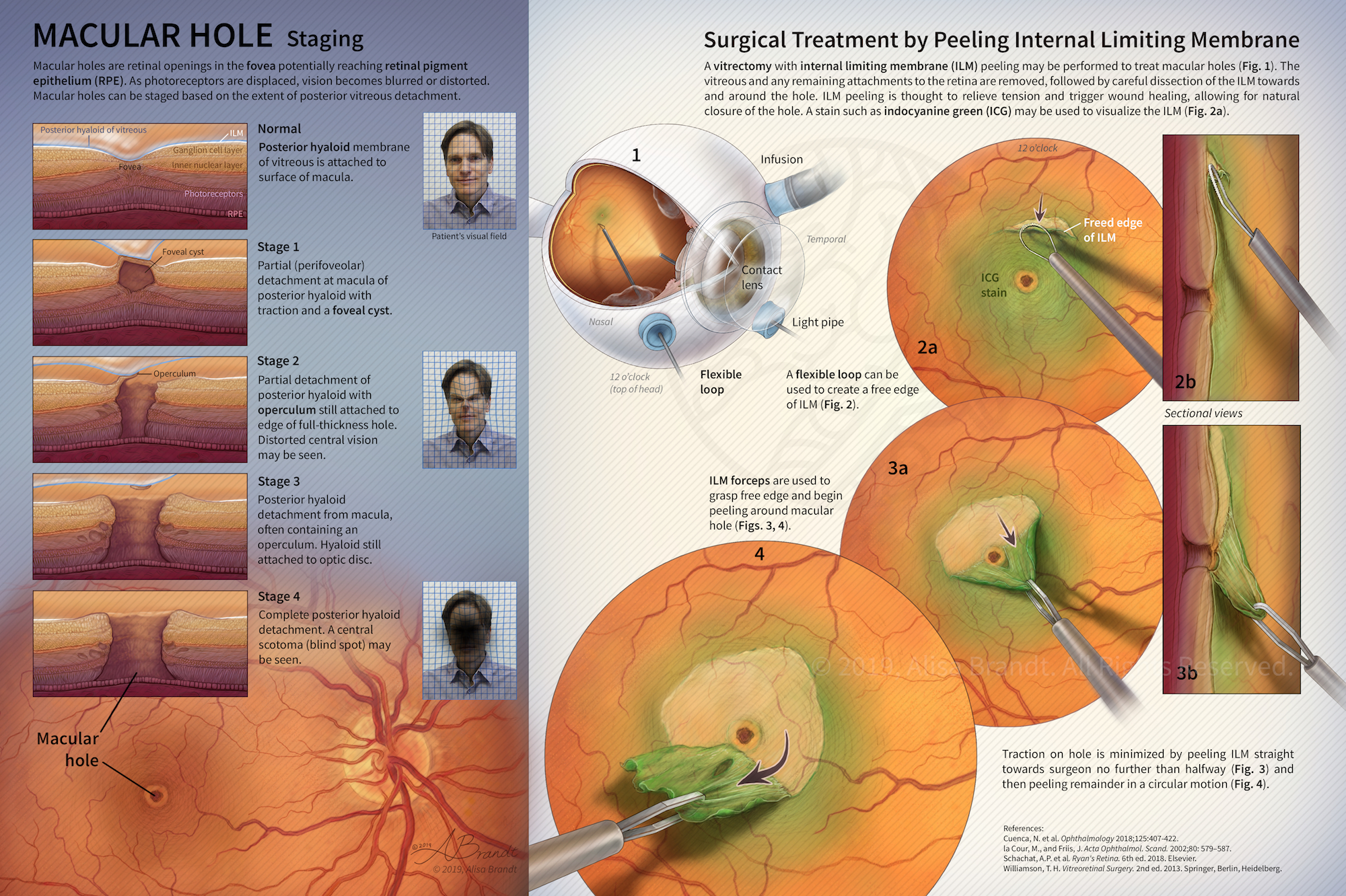 Macular hole staging and surgical treatment illustration © 2019 Alisa Brandt